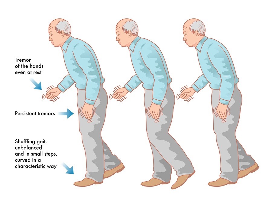 bệnh parkinson 